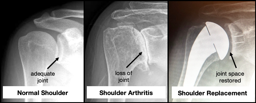 Total Shoulder Arthroplasty | Sierra Pacific Orthopedics